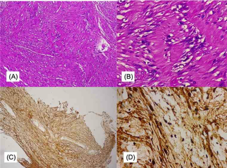 Transoral Endoscopic-Assisted Resection of Laryngeal Schwannoma: A Case Report.