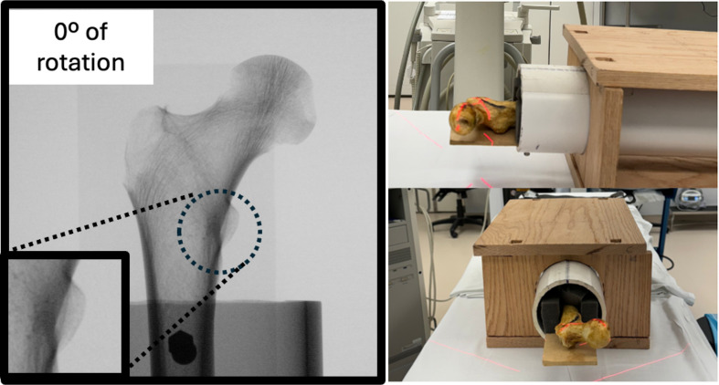 The lesser trochanter profile is an accurate and reliable measure of femoral rotation for intramedullary nailing.