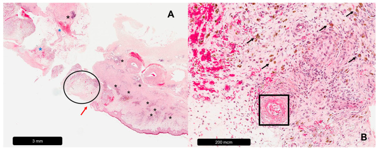 The Histopathology of Leg Ulcers.