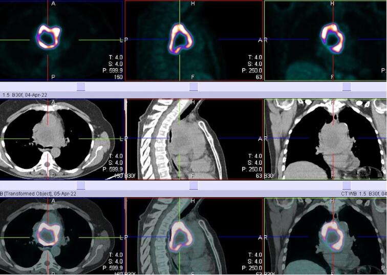 Effectiveness of cardiopulmonary bypass for radical resection of giant middle mediastinal paraganglioma.