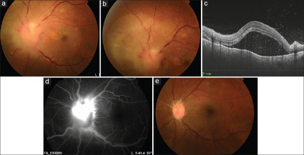 Optic Nerve Head Infiltration in Presumed Tuberculous Uveitis.