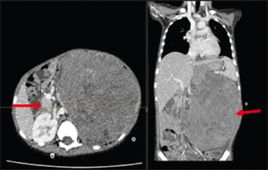 Emergency Angioembolization for Life-Threatening Hemorrhage in Wilms Tumor.