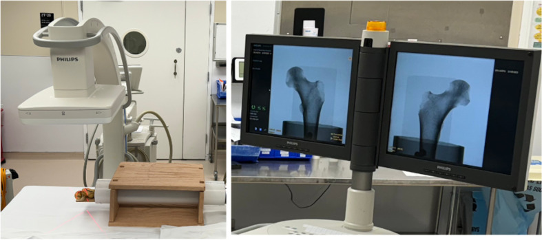 The lesser trochanter profile is an accurate and reliable measure of femoral rotation for intramedullary nailing.