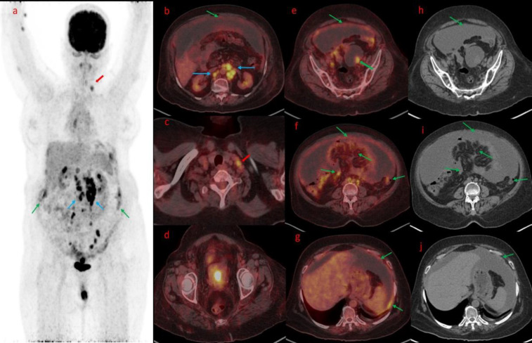 Unveiling the Metabolic Maze: FDG PET/CT Findings in Peritoneal Carcinomatosis - A Case Series.
