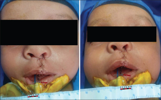 Comparative Study between Modified Millard and White Roll Vermilion Flap Techniques in Unilateral Lip Repair: A Randomised Controlled Study.