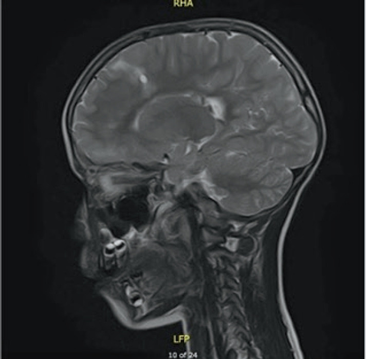 Novel Intronic Heterozygous Mutation in TSC2 Gene in Pediatric Patient with Tuberous Sclerosis Complex.