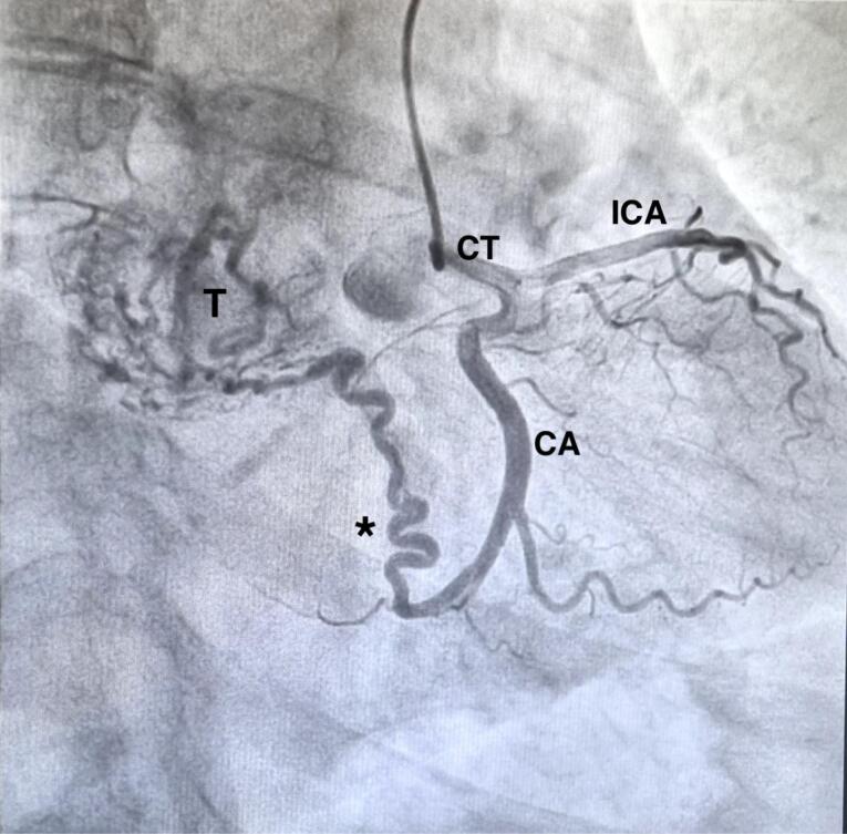 Effectiveness of cardiopulmonary bypass for radical resection of giant middle mediastinal paraganglioma.