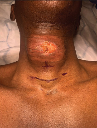 Head-and-neck Cancer in the Emergency Department: A Contemporary Review of Common Presentations and Management.