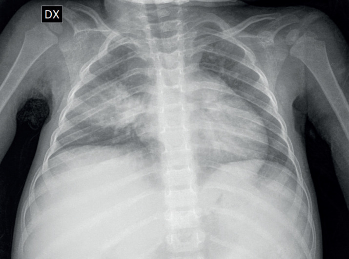 Miliary Tuberculosis in a Two-Year-Old Child: A Case Report from a Low-Prevalence Region.
