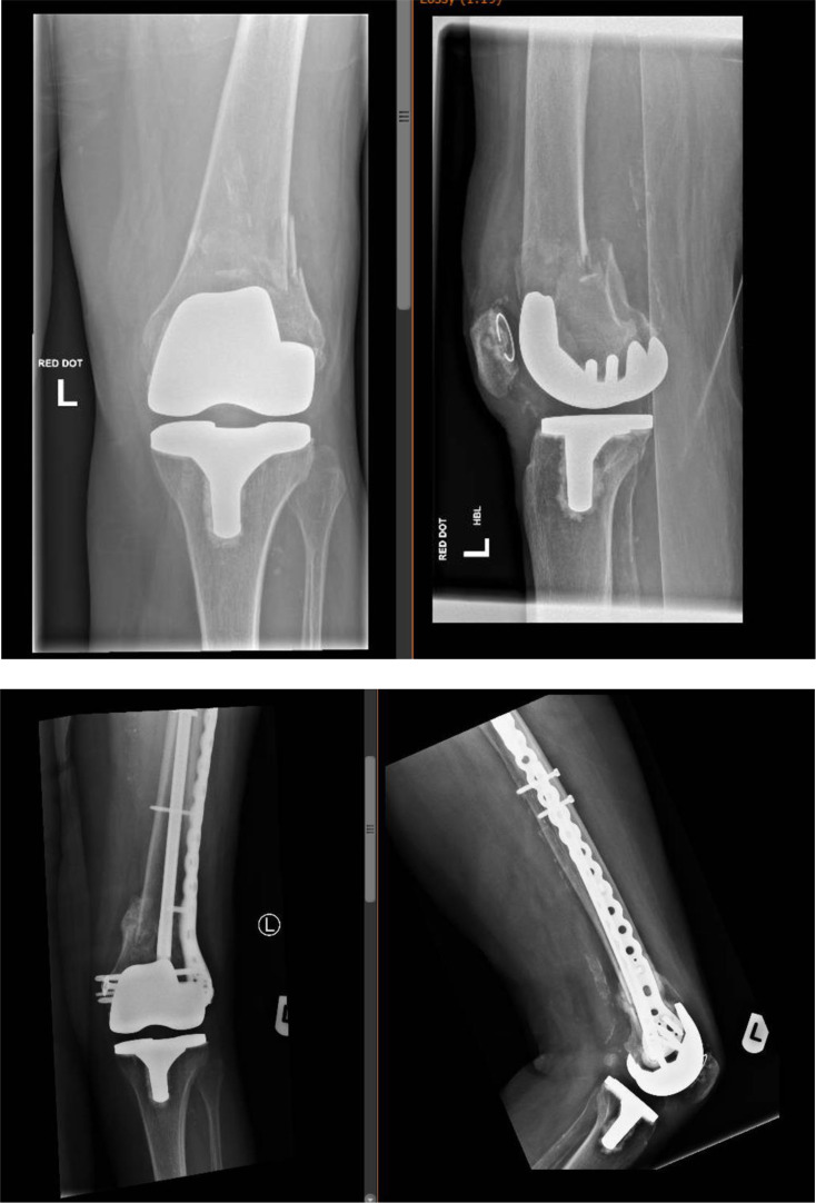 The linked nail/plate construct for the management of distal femur fractures in the elderly.