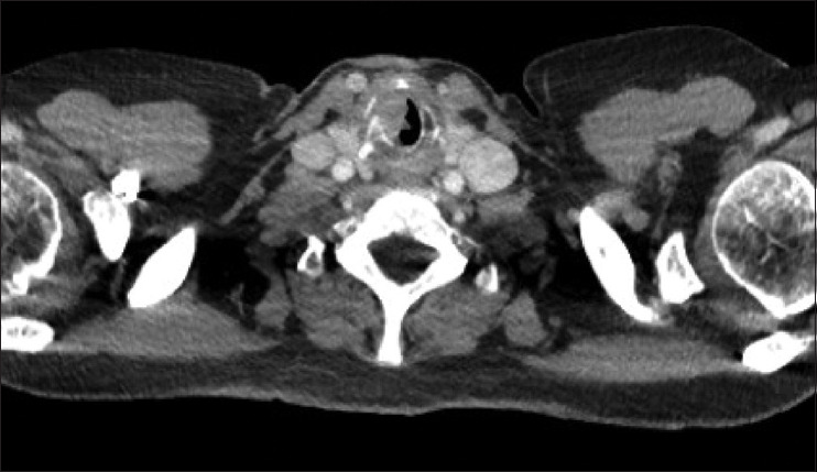 Head-and-neck Cancer in the Emergency Department: A Contemporary Review of Common Presentations and Management.