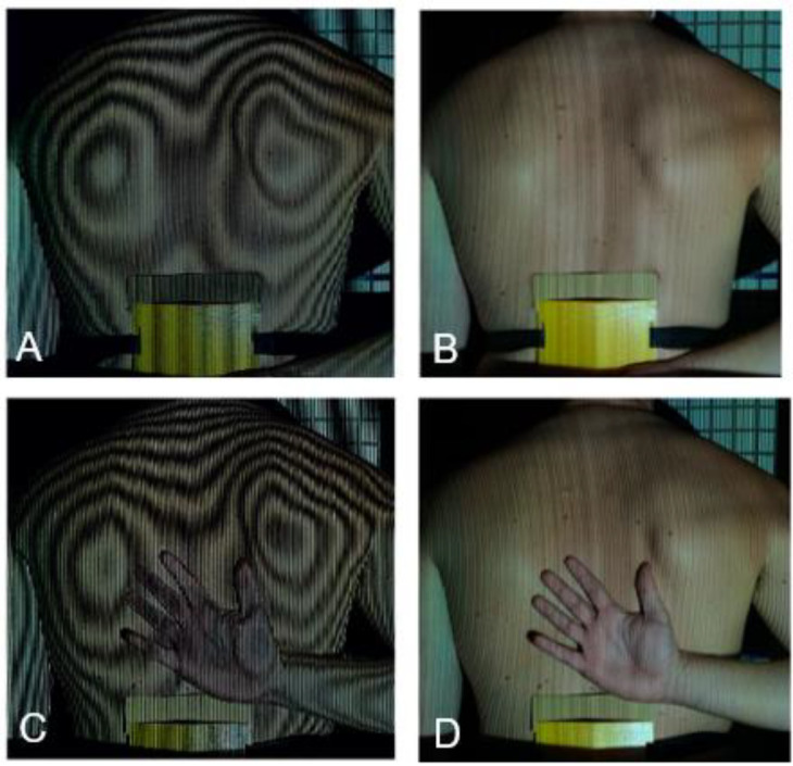 Quantitative Analysis of Scapular Winging Using Moire Topography.
