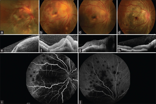 Optic Nerve Head Infiltration in Presumed Tuberculous Uveitis.