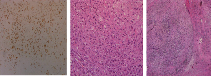 Sporadic Malignant Triton Tumor of Shoulder: a Case Report.