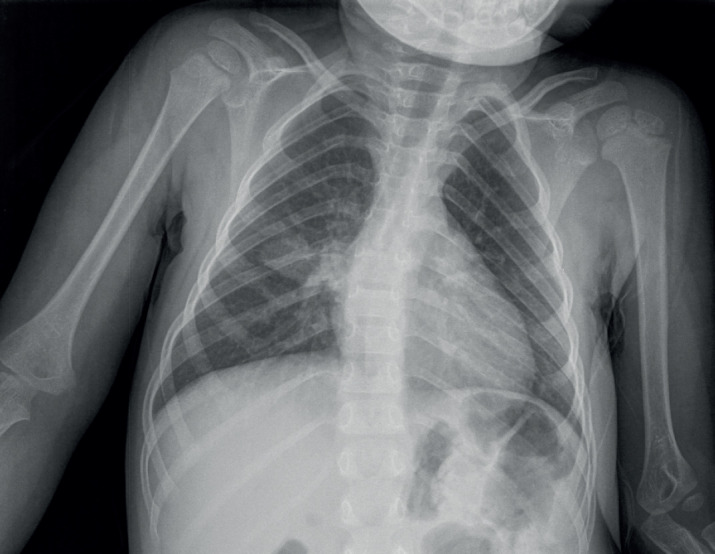 Miliary Tuberculosis in a Two-Year-Old Child: A Case Report from a Low-Prevalence Region.