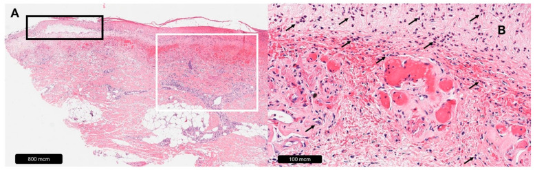 The Histopathology of Leg Ulcers.