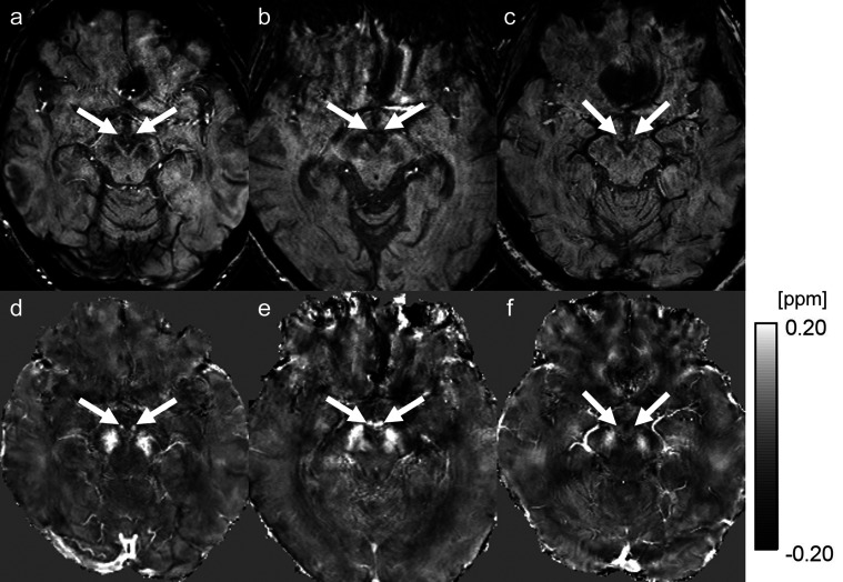 Hemosiderin Detection inside the Mammillary Bodies Using Quantitative Susceptibility Mapping on Patients with Wernicke-Korsakoff Syndrome.