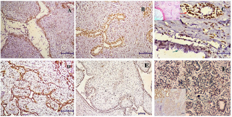 Cytoplasmic Expression of p16 Is Associated with Carcinoma Breast: It Is Not an Artifact.