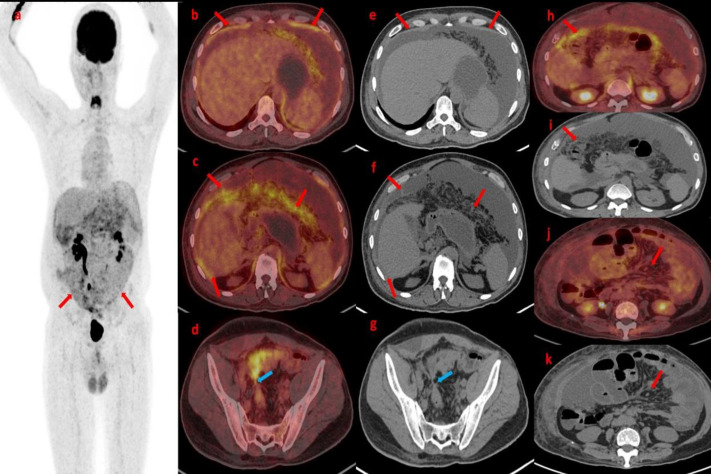 Unveiling the Metabolic Maze: FDG PET/CT Findings in Peritoneal Carcinomatosis - A Case Series.