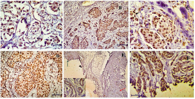 Cytoplasmic Expression of p16 Is Associated with Carcinoma Breast: It Is Not an Artifact.
