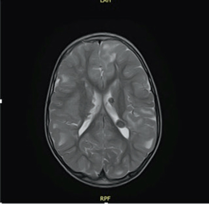 Novel Intronic Heterozygous Mutation in TSC2 Gene in Pediatric Patient with Tuberous Sclerosis Complex.