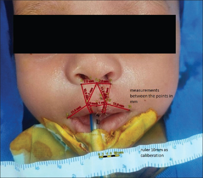 Comparative Study between Modified Millard and White Roll Vermilion Flap Techniques in Unilateral Lip Repair: A Randomised Controlled Study.