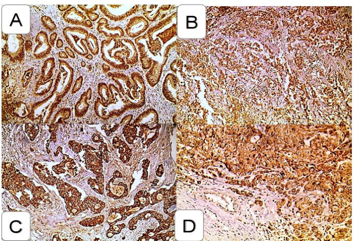Role of CTLA4 and pSTAT3 Immunostaining in Prognosis and Treatment of the Colorectal Carcinoma.