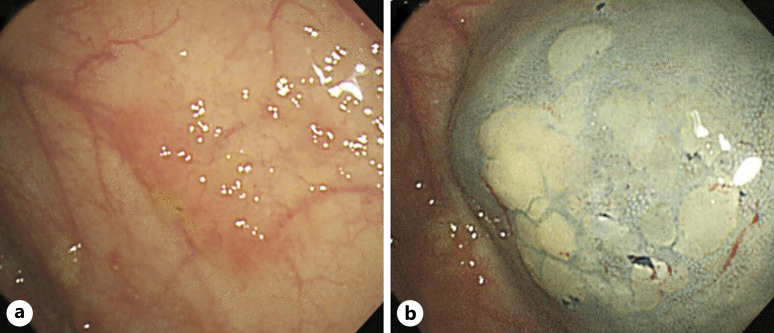 Considerations for Colorectal Neoplasia Detection in Inflammatory Bowel Disease Clinical Trials.