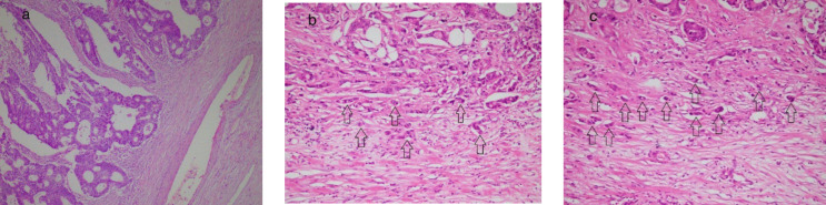 Histopathologic and Prognostic Significance of Tumor Budding in Colorectal Adenocarcinoma: A Retrospective Cohort Study Conducted in Shiraz, Iran.