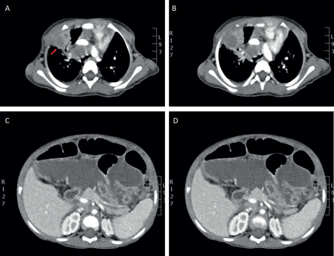 Miliary Tuberculosis in a Two-Year-Old Child: A Case Report from a Low-Prevalence Region.