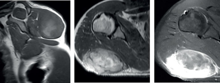 Sporadic Malignant Triton Tumor of Shoulder: a Case Report.