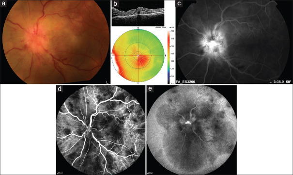 Optic Nerve Head Infiltration in Presumed Tuberculous Uveitis.