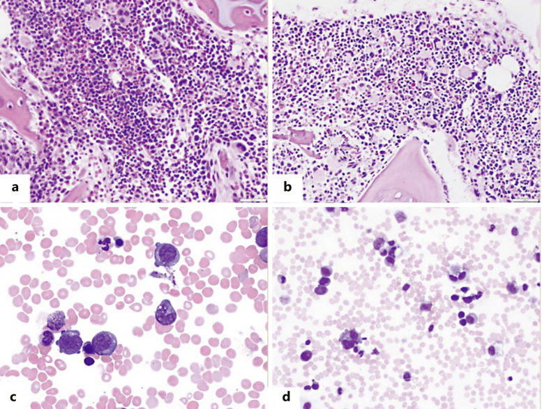 Myeloid Proliferations Associated with Down Syndrome: Clinicopathologic Characteristics of Forty Cases from Five Large Academic Institutions.