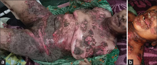 Pemphigus vulgaris in association with human immunodeficiency virus infection: A management dilemma.