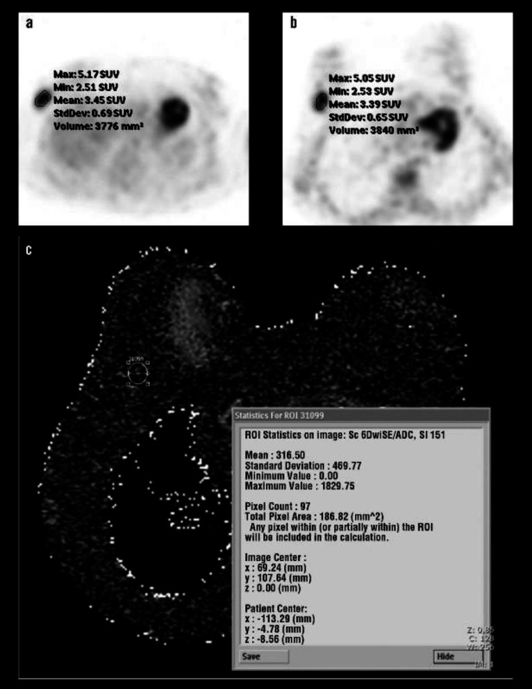 Comparison between <sup>18</sup>F-FDG PET/CT and diffusion-weighted imaging in detection of invasive ductal breast carcinoma.