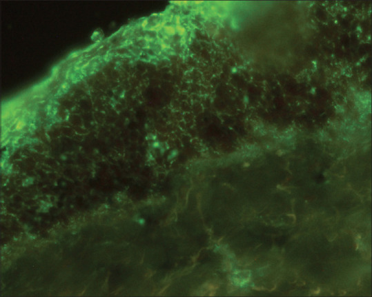 Pemphigus vulgaris in association with human immunodeficiency virus infection: A management dilemma.