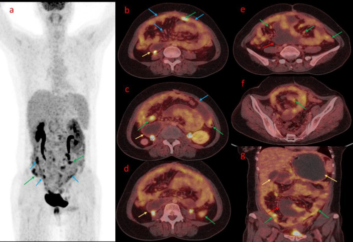 Unveiling the Metabolic Maze: FDG PET/CT Findings in Peritoneal Carcinomatosis - A Case Series.