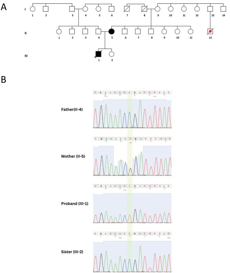 A Mutational Hotspot in The <i>LAMP2</i> Gene: Unravelling Intrafamilial Phenotypic Variation and Global Distribution of The c.877C>T Variant: A Descriptive Study.
