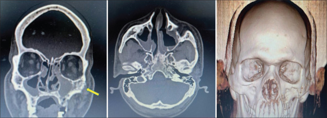 Osteomyelitis of the Jaw Due to Mucormycosis after Coronavirus Disease 2019 Infection - A Prospective Study.