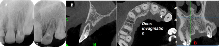 Photodynamic Therapy in a Lateral Maxillary Incisor with Dens in Dente Type Ⅱ and Primary Endodontic Lesion: Case Report.