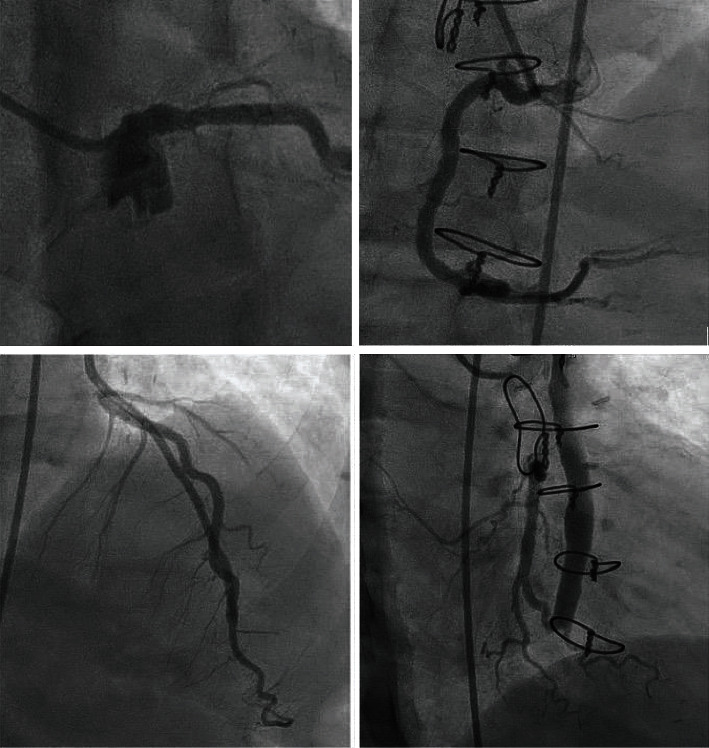 Rare Manifestation of COVID-19 Resulting in Coronary Artery Vasculitis.