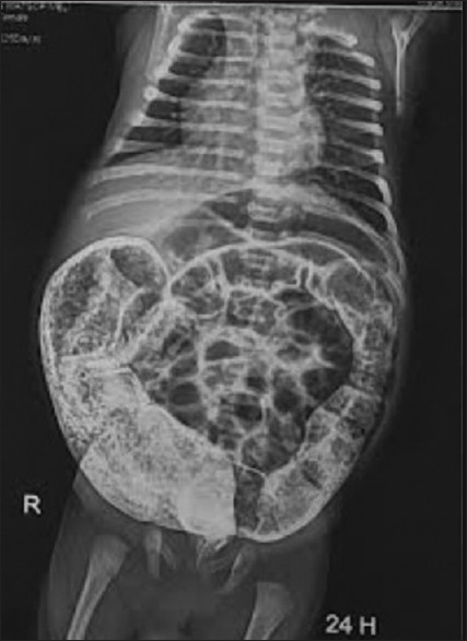 Our Experience of the De la Torre-Mondragon Technique in the Surgical Management of Hirschsprung's Disease: A Report on 52 Cases.