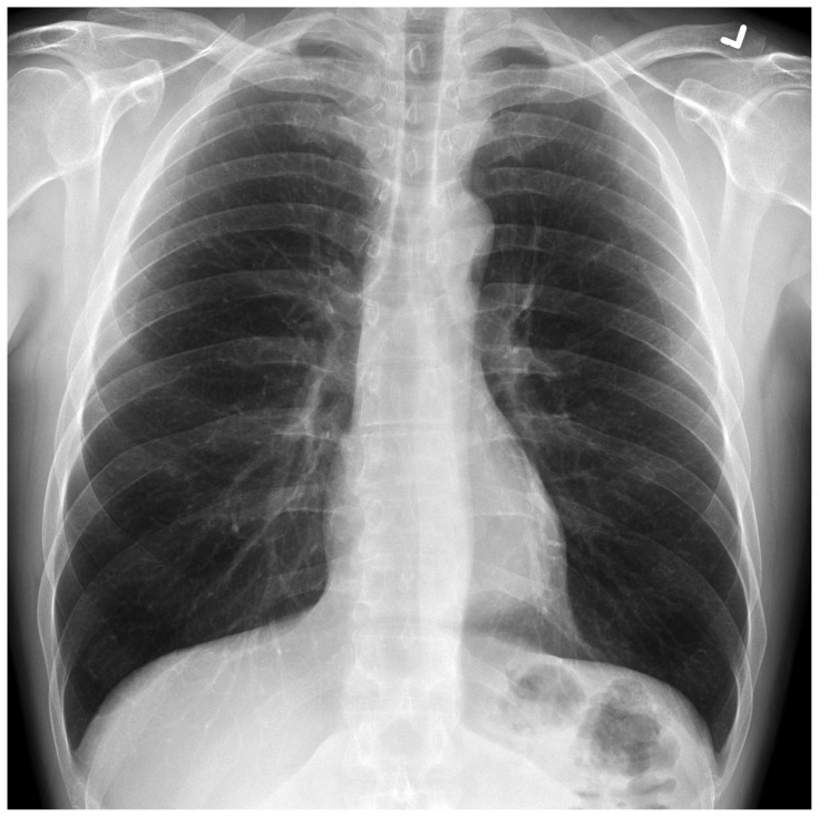 Calcium Channel Blocker Overdose.