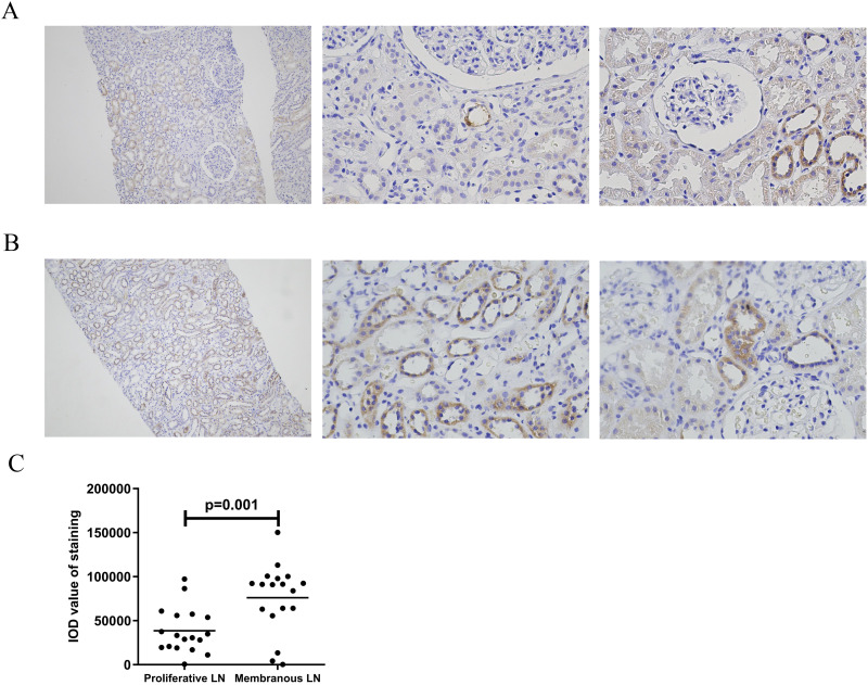 Association of Mitochondrial Pyruvate Carrier with the Clinical and Histological Features in Lupus Nephritis.