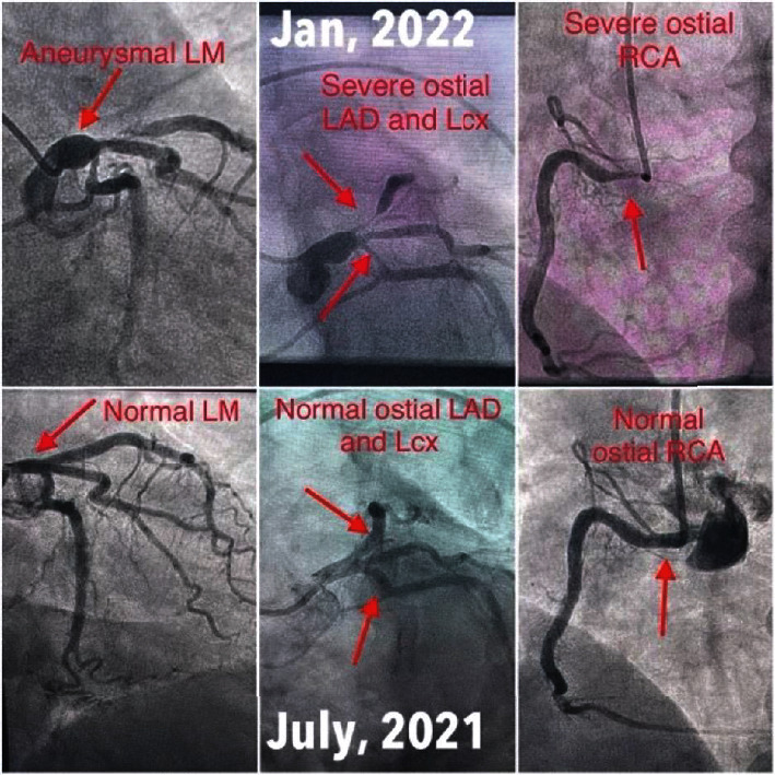 Rare Manifestation of COVID-19 Resulting in Coronary Artery Vasculitis.
