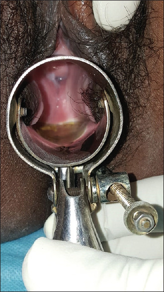 Syndromic diagnosis, sexual behavior, and management in rural population among all cases attending sexually transmitted infection clinic in a tertiary care center from the east-central zone of India: A retrospective study.