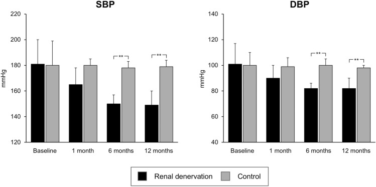 Renal Denervation in End-Stage Renal Disease: Current Evidence and Perspectives.