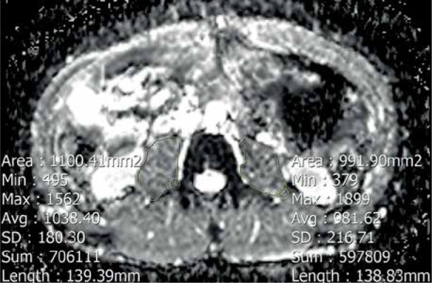 Diagnostic value of apparent diffusion coefficient of psoas muscles for evaluating complications in patients with Crohn's disease.