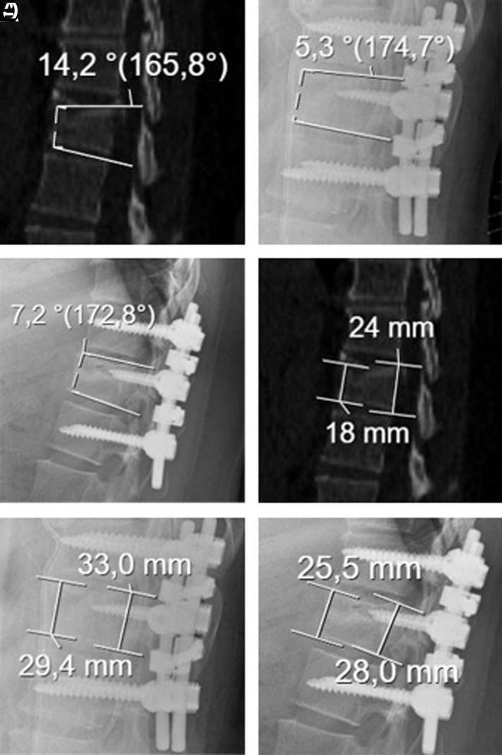 The effect of the size of pedicle screw on the long-term radiological and clinical results of short-segment posterior instrumentation in the management of thoracolumbar vertebral fractures.