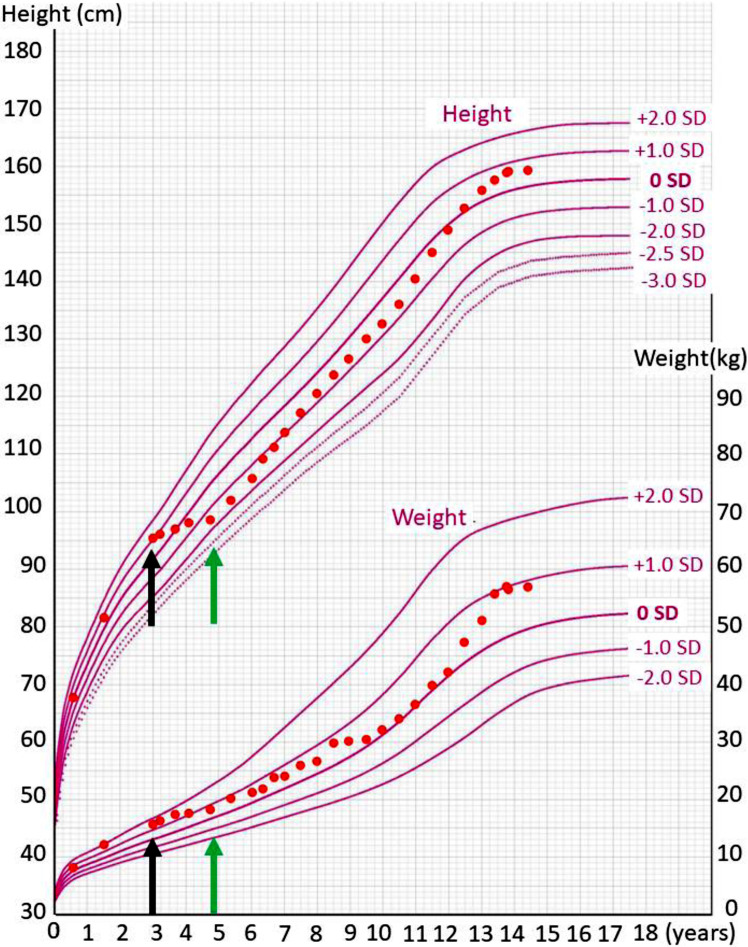 Severe growth retardation during carbohydrate restriction in type 1 diabetes mellitus: A case report.